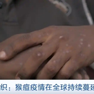 世衛(wèi)組織：猴痘病毒Ib分支引起的疫情在全球持續(xù)蔓延